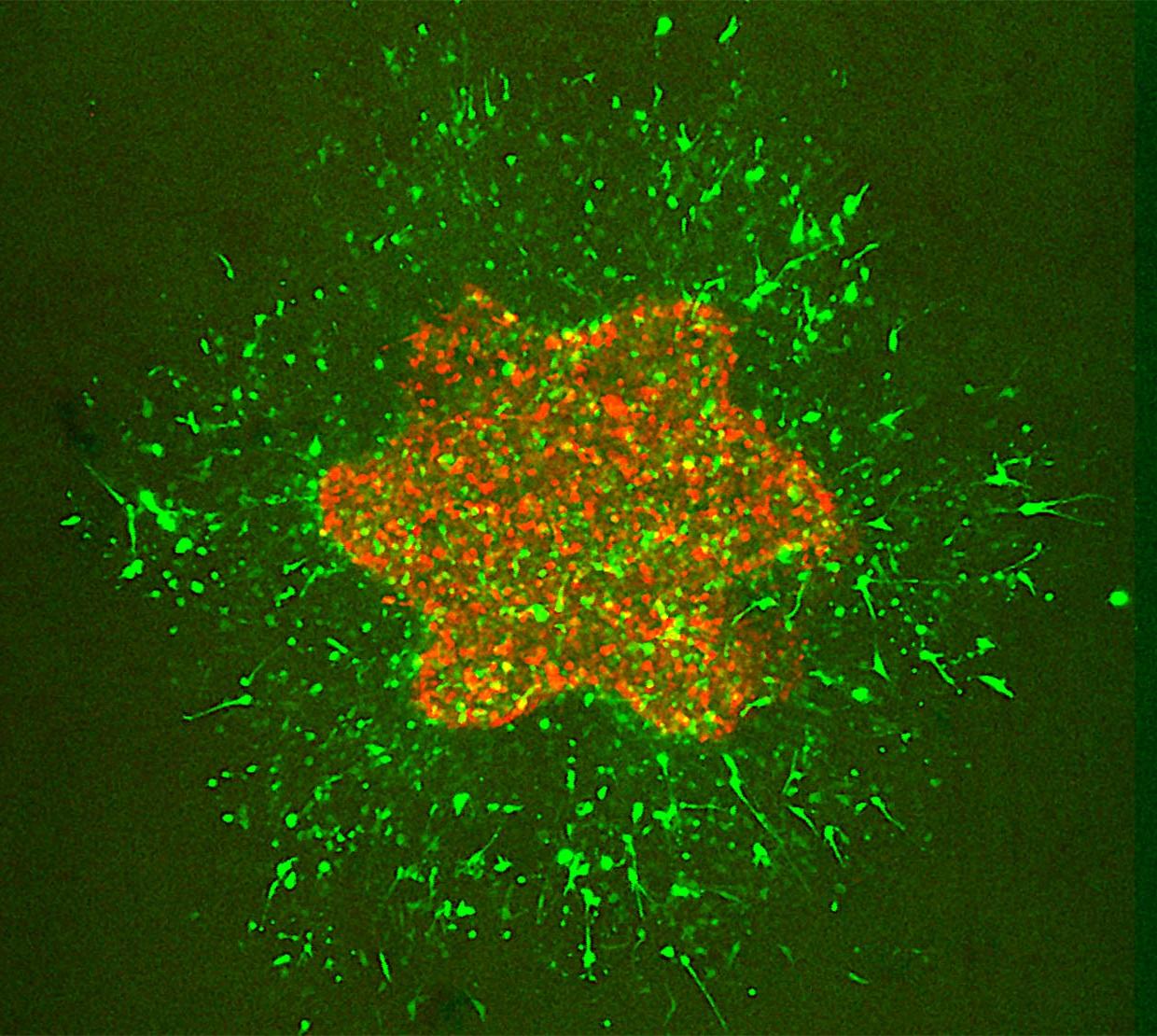 microscopic view of breast tumor cells