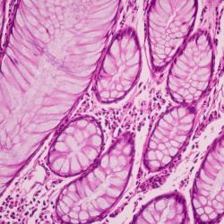 Cancer cells